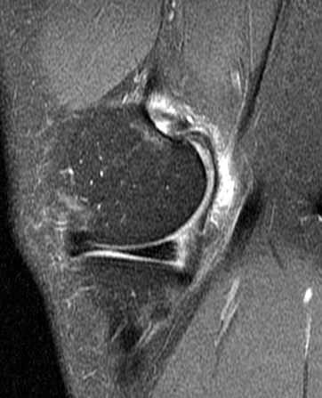 Figure 2 for case Partial tear of the tendon of the medial head of the gastrocnemius muscle ( RID2921 )